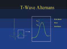T-wave